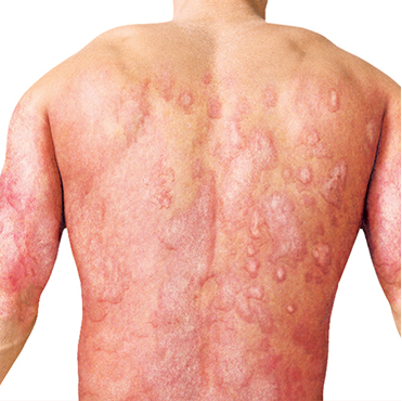 Psoriasis rash on back