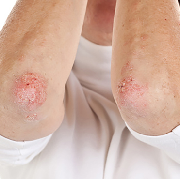 Psoriasis rash on elbows