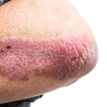 Psoriasis rash on elbow