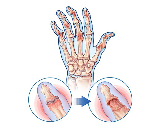 Psoriatic Arthritis Symptoms - swollen fingers