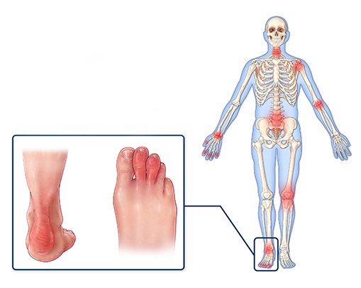Psoriatic Arthritis Symptoms - joint pain and ankle pain