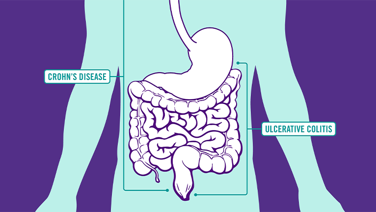 How STELARA® works for Crohn's Disease and Ulcerative Colitis Five dollar icon